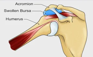 2025 CPG rehberliğinde rotator cuff tendinopatisi (RCRSP) tedavisi için fizyoterapist eşliğinde Prone Y/T egzersizi ile skapular stabilizasyon ve kontrollü yükleme.