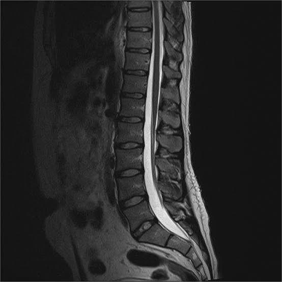Sagittal lumbar spine MRI image showing lumbar disc structure and possible disc herniation findings