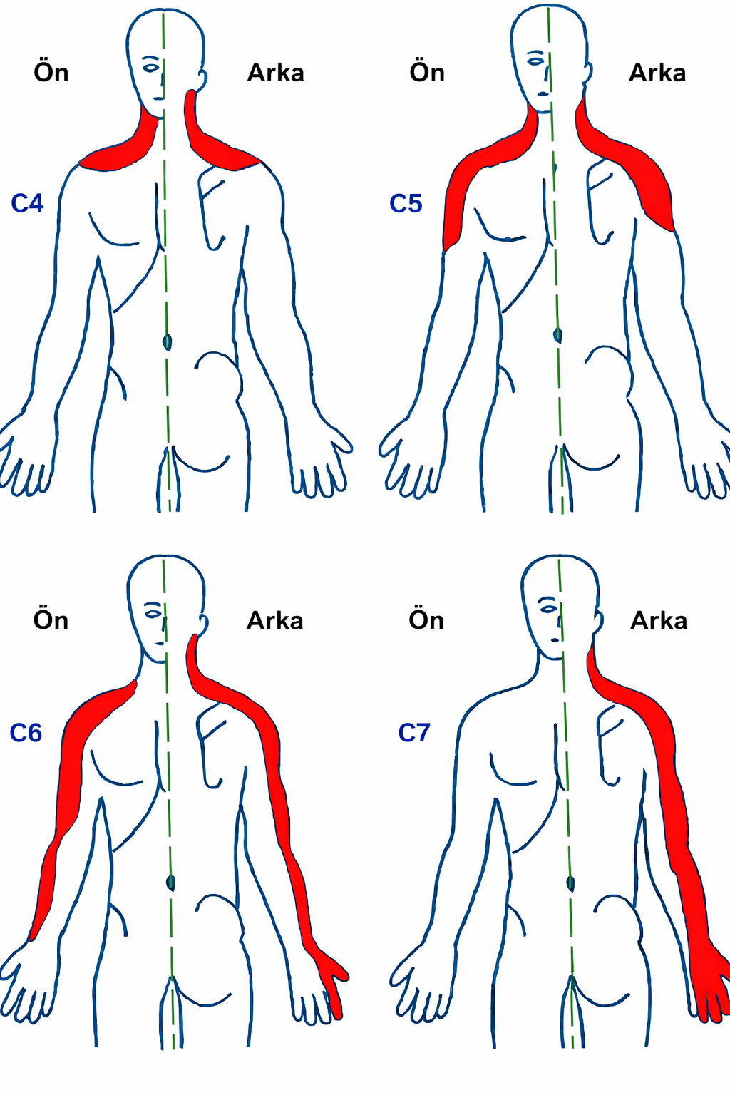 C4, C5, C6 ve C7 sinir köklerinin dermatom haritası — boyun ve kol bölgesinde ağrı, uyuşma ve karıncalanma dağılımı.