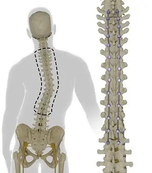 Omurgada lateral eğrilik ve rotasyonel deformite gösteren anatomik görsel