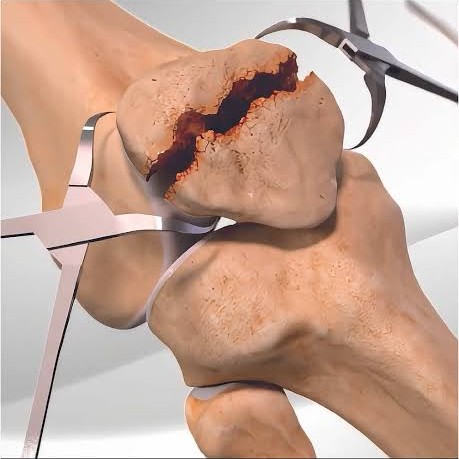 patella kırığı sonrası rehabilitasyon fizik tedavi